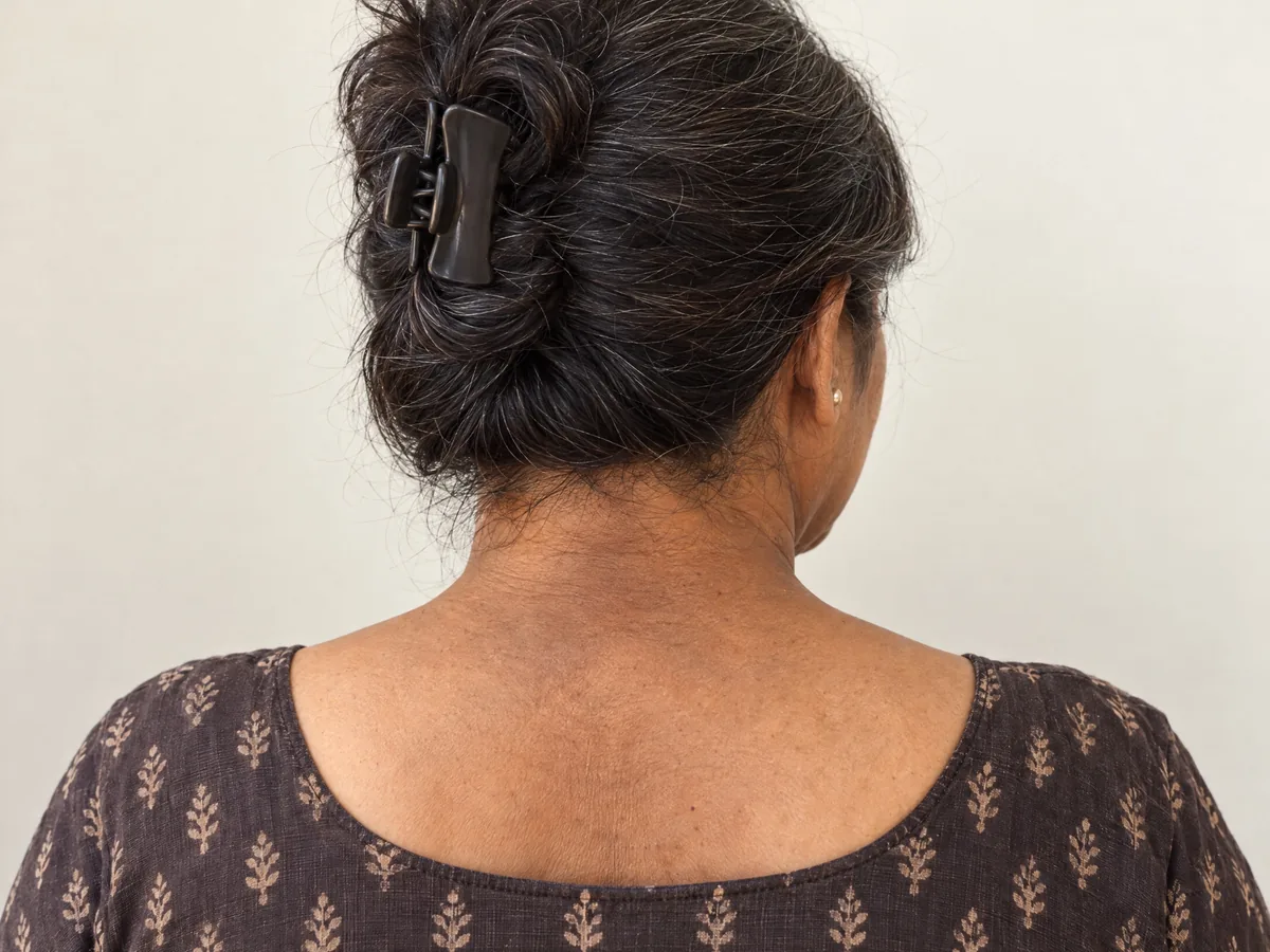 AI Aesthetics Skin Clinic by Dr. Aakriti Mehra: Neck and Back Pigmentation Treatment in Jaipur, Neck back pigmentation, close-up on Indian skin, assessed