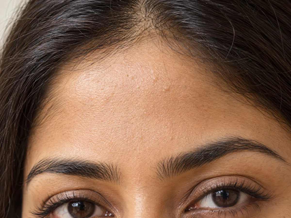 AI Aesthetics Skin Clinic by Dr. Aakriti Mehra: Skin Texture Treatment in Jaipur, Skin texture, close-up on Indian skin, assessed