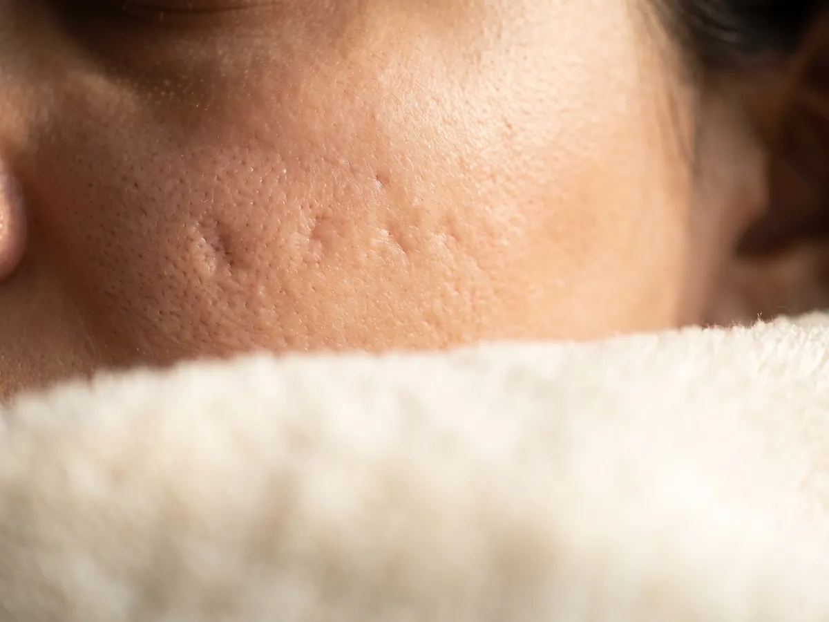 Face Laser Hair Removal Jaipur: A dupatta, scarf or cap on the face when riding a two-wheeler in, Acne scars: shallow pitted scars in | AI Aesthetics, C-Scheme