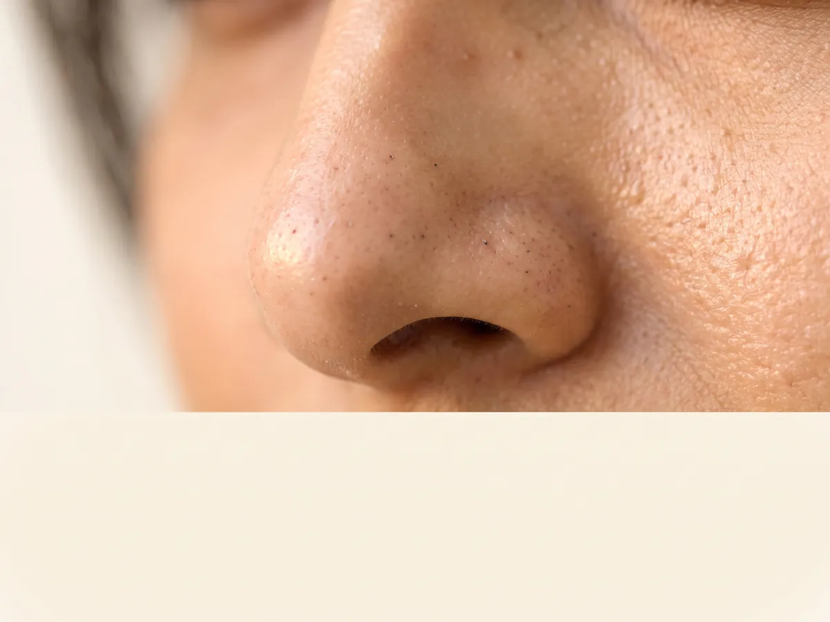 AI Aesthetics Skin Clinic by Dr. Aakriti Mehra: Blackheads and Whiteheads Treatment in Jaipur, Blackheads: nose macro with blackheads