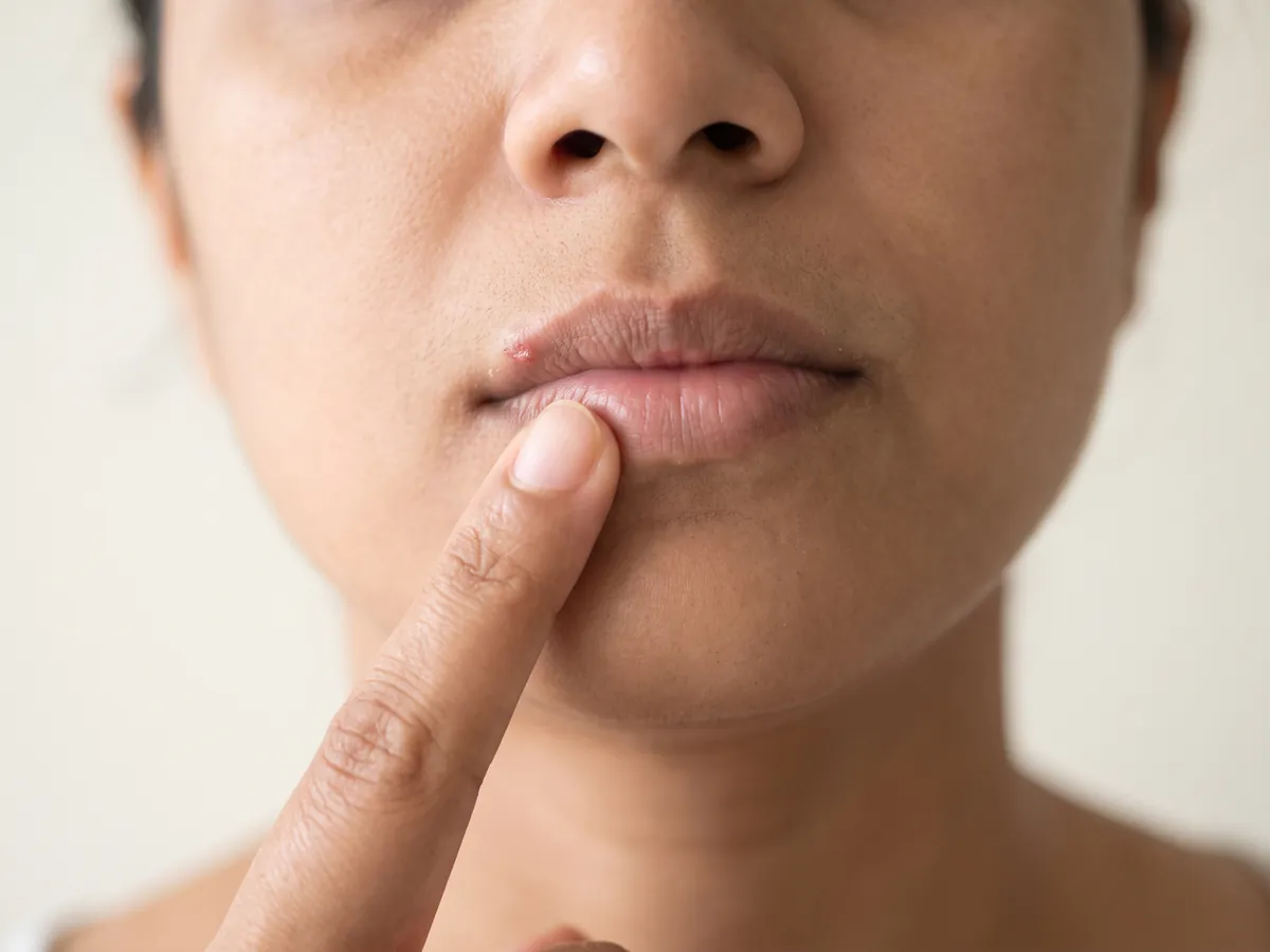 Dermal Fillers in Jaipur: Active herpes outbreak or cold sore, Cold sore: a client touching the corner of her lip | AI Aesthetics, C-Scheme