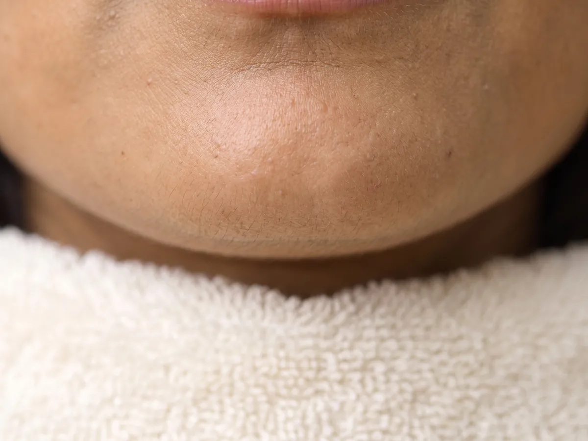 Oily Skin Treatment in Jaipur: Blackheads and congestion, Congestion: small bumps and clogged pores on the chin, macro | AI Aesthetics, C-Scheme
