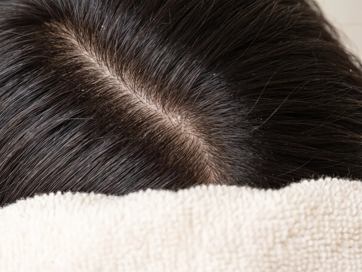 Exosome Hair Treatment Jaipur: Scalp health, Dandruff: flakes along a scalp parting, macro | AI Aesthetics, C-Scheme
