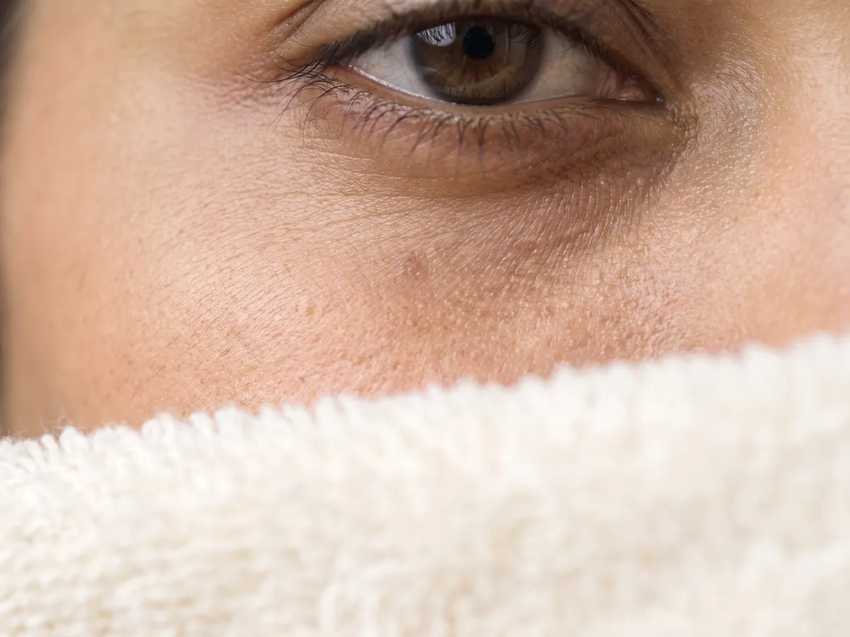 Fine Lines and Wrinkles Treatment Jaipur: Under-eye lines with hollows, Dark circles: under-eye darkness close-up | AI Aesthetics, C-Scheme