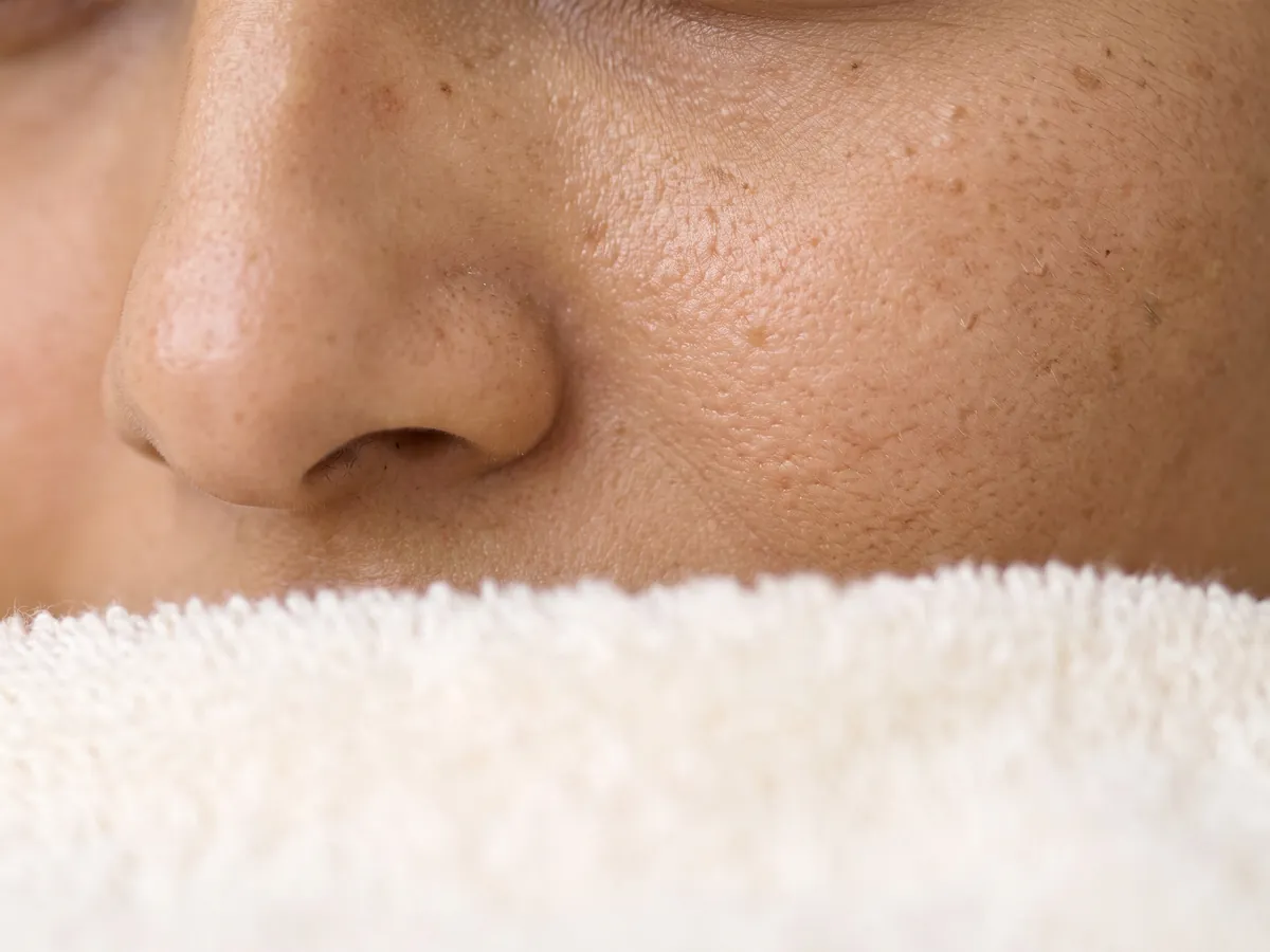 Fine Lines and Wrinkles Treatment Jaipur: Dark spots: a few dark spots near the nose, macro | AI Aesthetics, C-Scheme