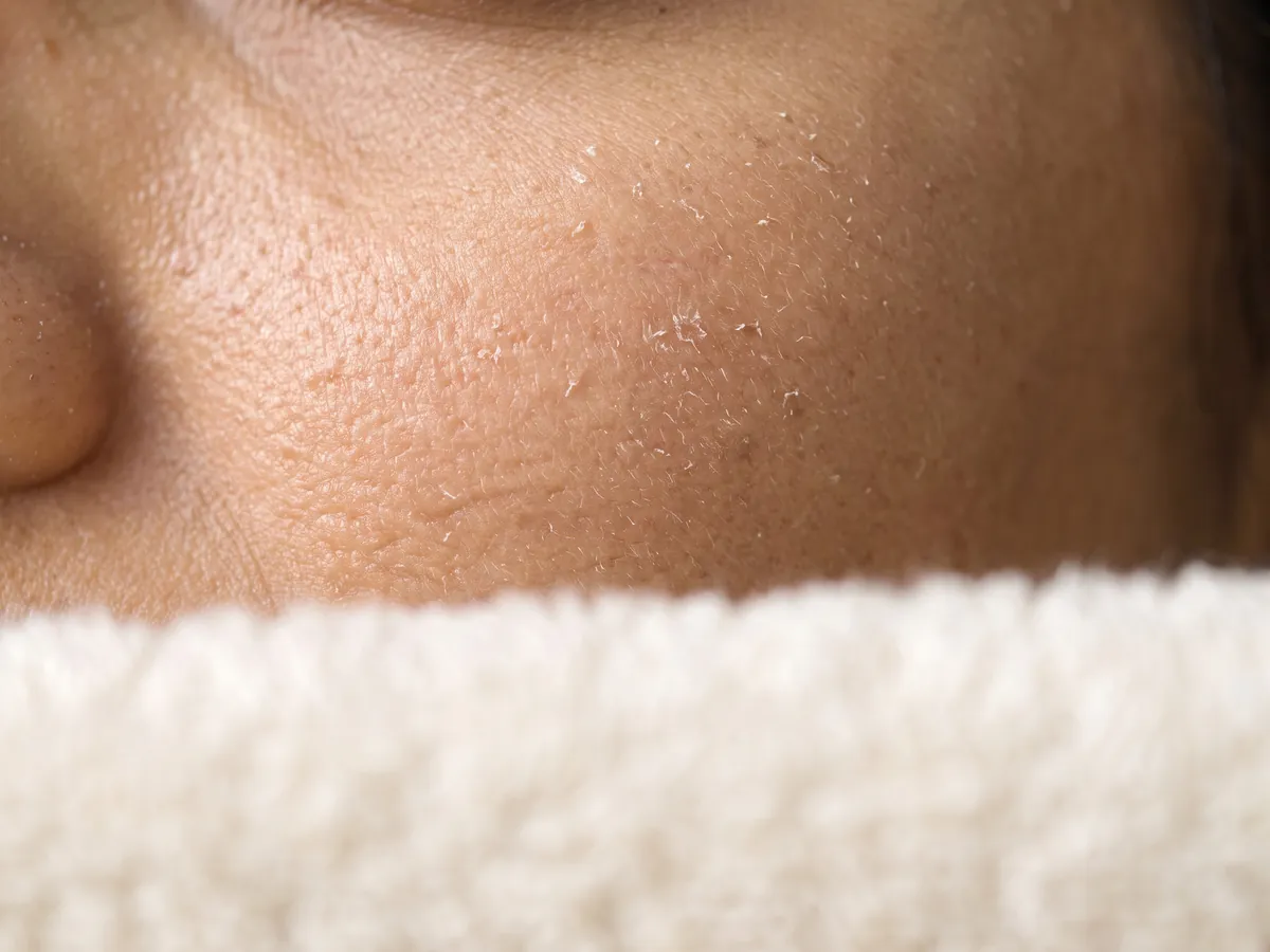 Face Laser Hair Removal in Jaipur: Visibility: any redness, dryness or patchy reduction shows, Dry skin: close-up of fine flaking on | AI Aesthetics, C-Scheme