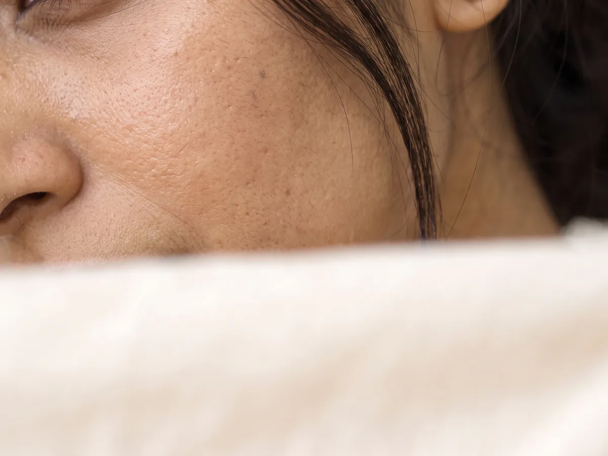 Skin Whitening Treatment Jaipur: Dull, uneven or patchy skin, Dull skin: flat, lacklustre cheek in grey daylight | AI Aesthetics, C-Scheme