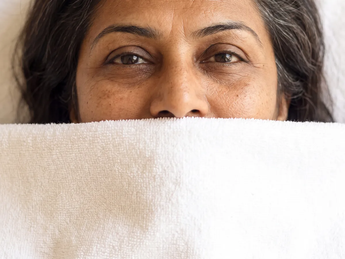 About AI Aesthetics: Melasma Treatment in Jaipur, Melasma: symmetrical cheek melasma, the client