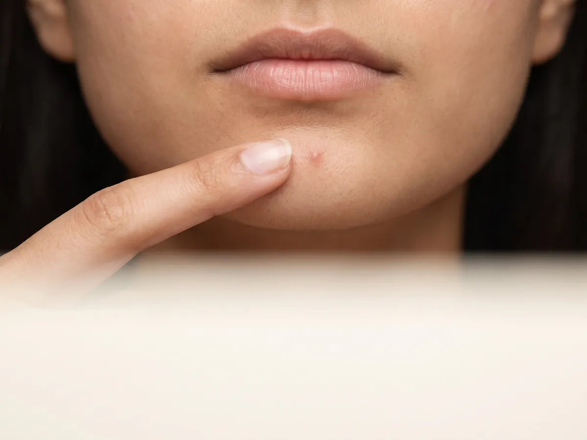 Ingrown Hair Treatment in Jaipur: Picking at bumps, Picking: a hand about to touch a pimple on the chin, close-up | AI Aesthetics, C-Scheme