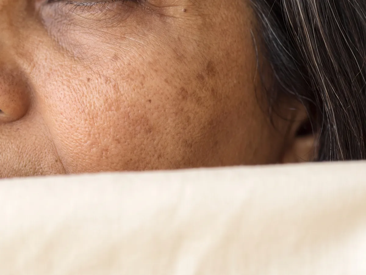 Skin Whitening Treatment in Jaipur: Neck and back, Pigmentation: brown patches on the cheek, the client | AI Aesthetics, C-Scheme