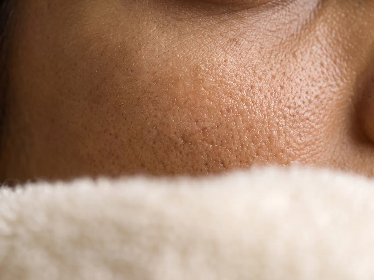 Oily Skin Treatment in Jaipur: Enlarged-looking pores, Pores: enlarged pores on the inner cheek, macro | AI Aesthetics, C-Scheme