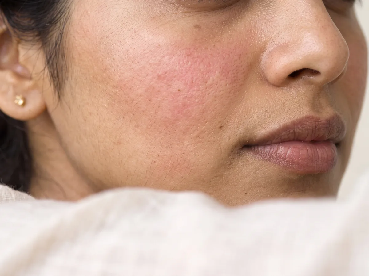 Face Laser Hair Removal Jaipur: Expect mild redness for a few hours; report any prolonged irritation, Redness: diffuse cheek redness | AI Aesthetics, C-Scheme