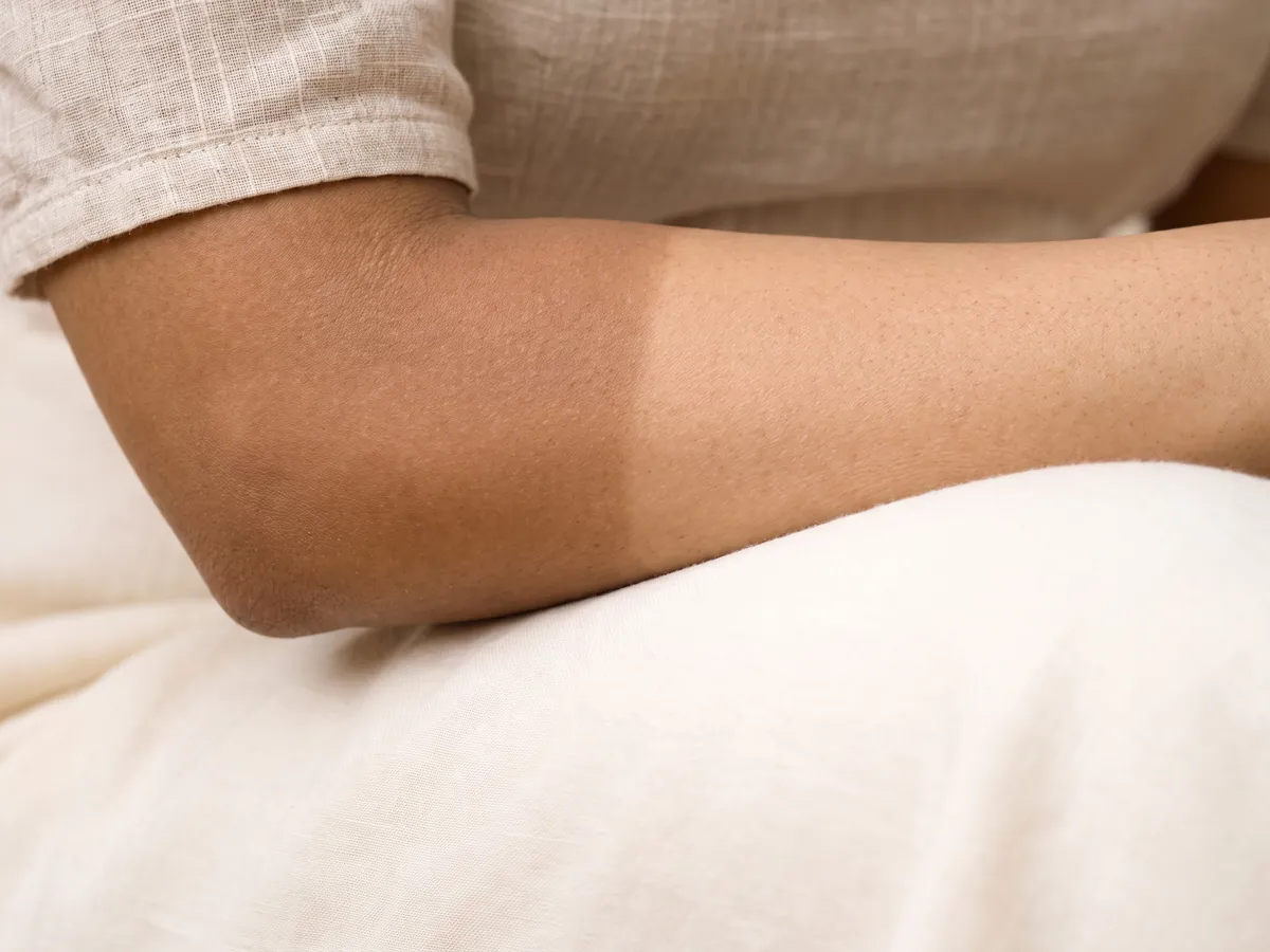 Skin Whitening Treatment Jaipur: Tan on the face fades faster when laser or a peel is added, Tan: a sleeve tan line on the forearm | AI Aesthetics, C-Scheme