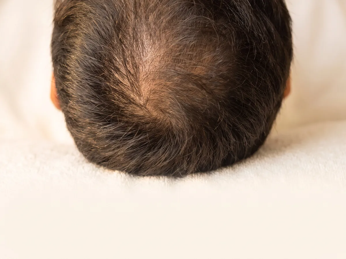 Ingrown Hair Treatment Jaipur: Hair density, Thinning: top-down crown parting | AI Aesthetics, C-Scheme