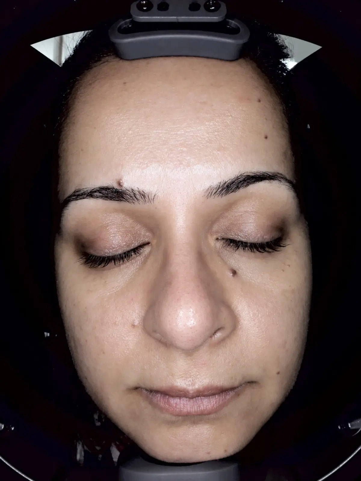 जयपुर में HydraFacial (हाइड्राफेशियल): After, The same client after a HydraFacial at AI Aesthetics, C-Scheme, Jaipur, photographed in the skin-analysis unit