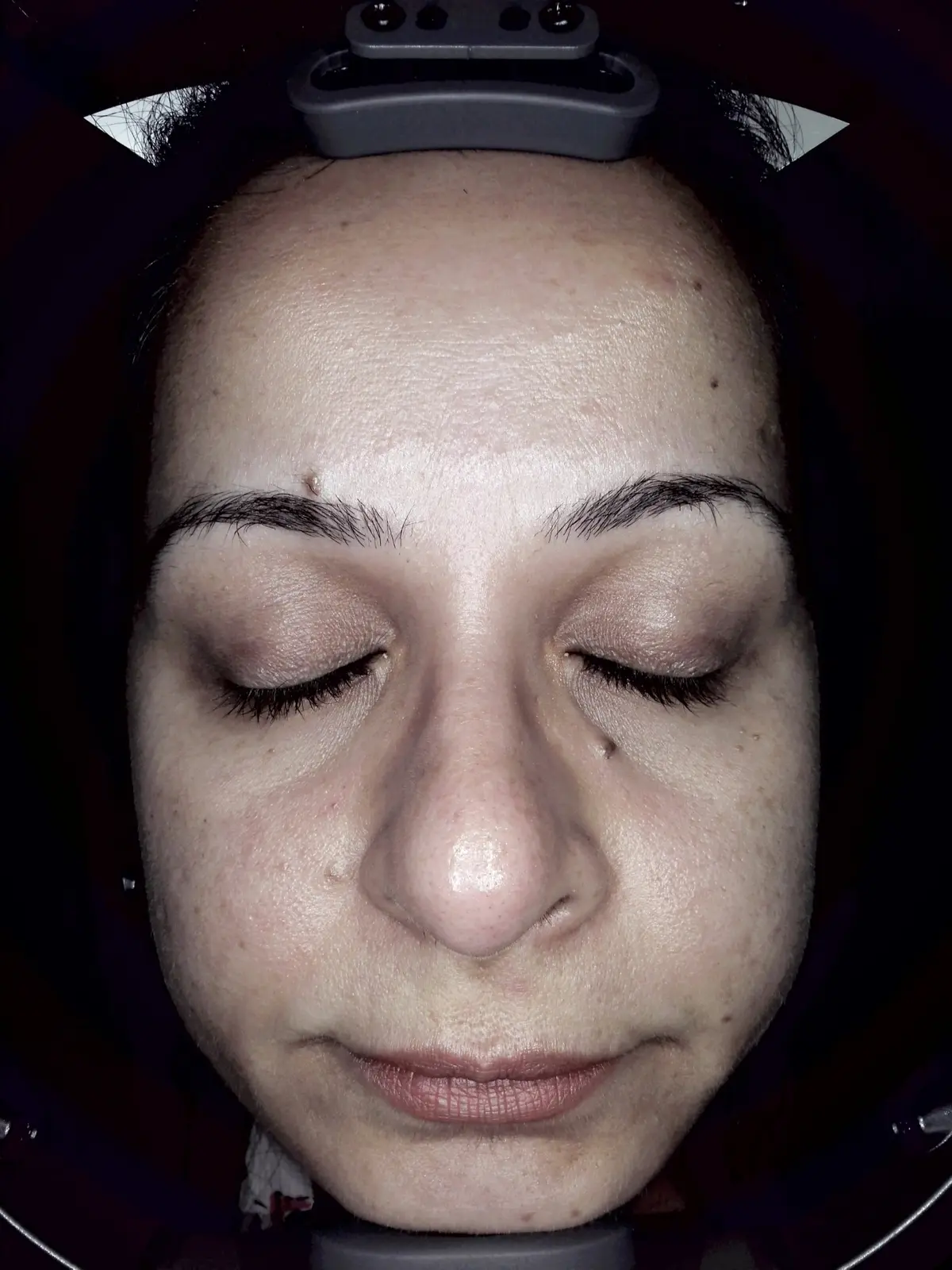 जयपुर में HydraFacial (हाइड्राफेशियल): Before, Client's face before a HydraFacial at AI Aesthetics, C-Scheme, Jaipur, photographed in the skin-analysis unit