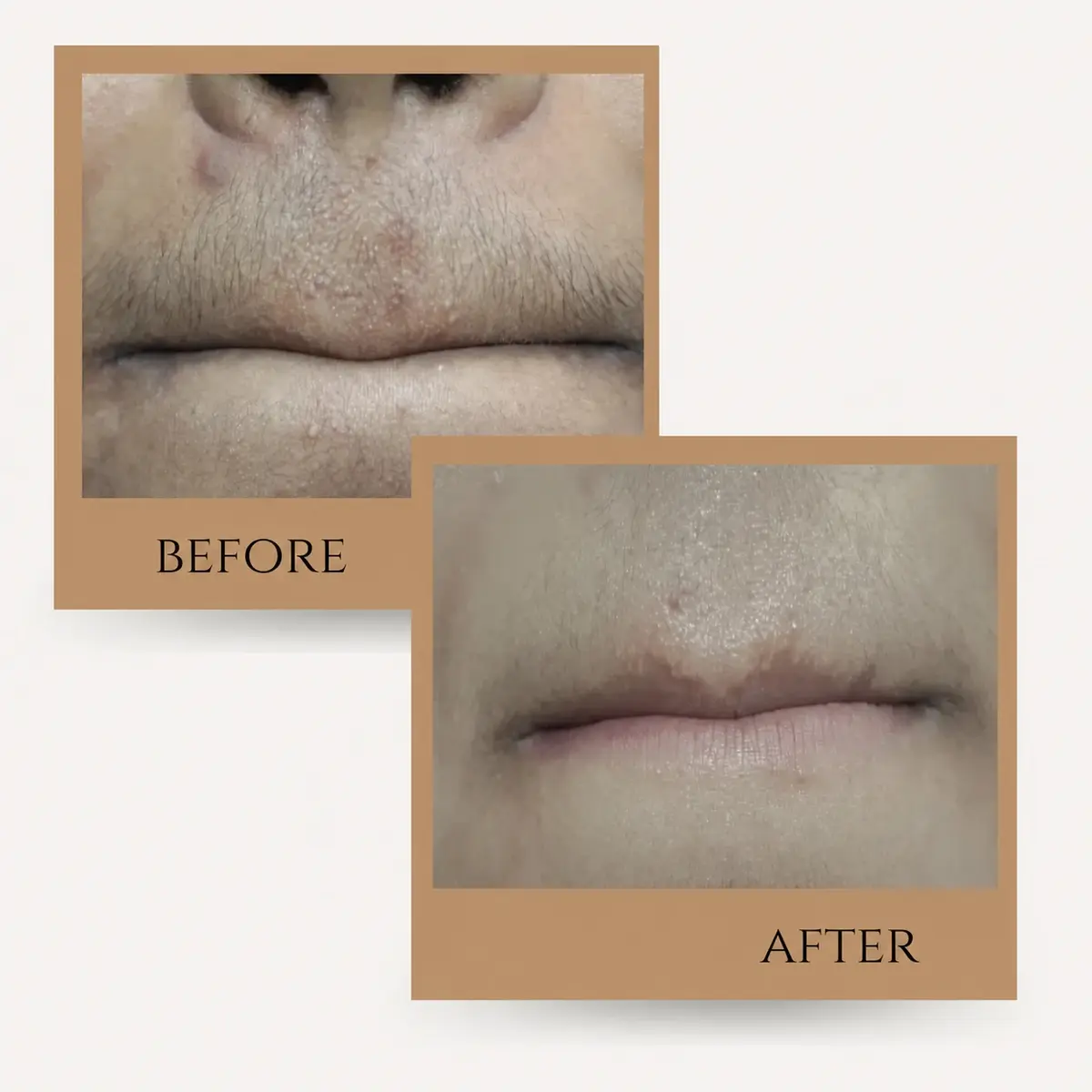 जयपुर में लेज़र हेयर रिमूवल: Upper lip before and after a course of laser hair removal | AI Aesthetics, C-Scheme, Jaipur